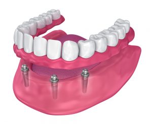 tandprotese